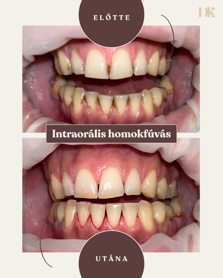 Intraorális homokfúvás