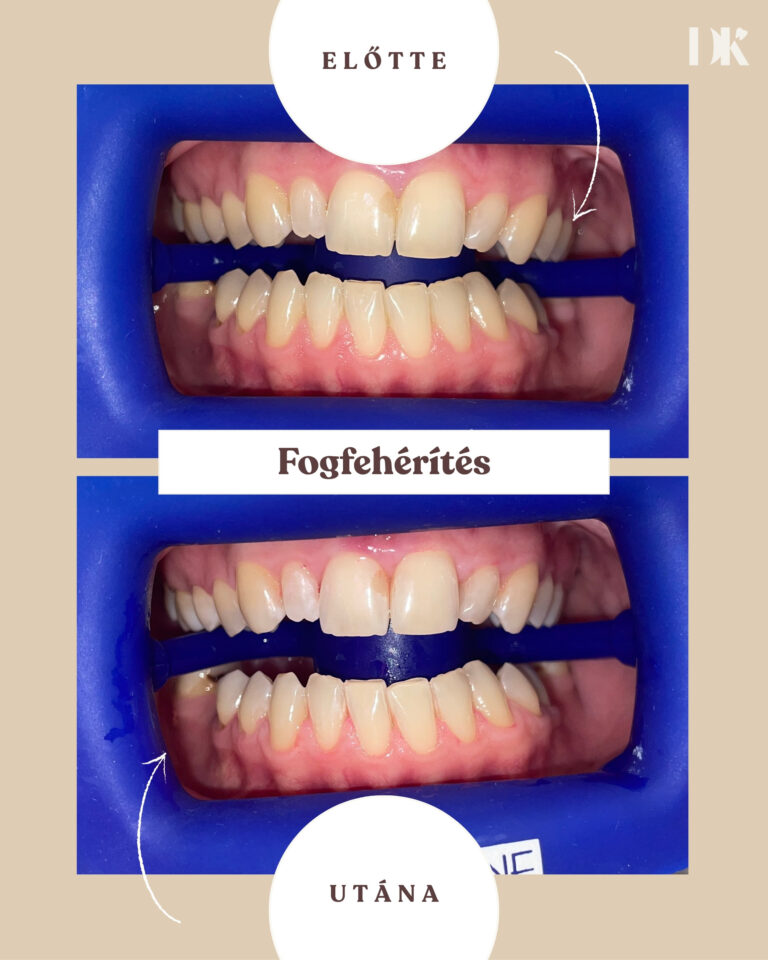 Fogfehérítés