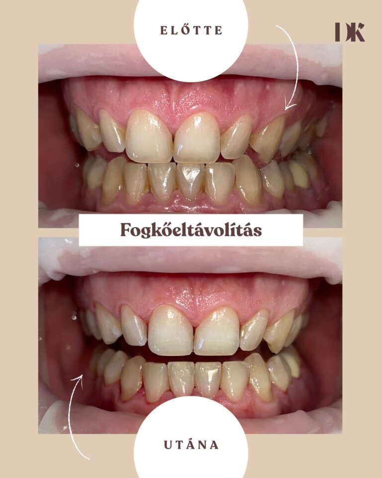 Professzionális ogkőeltávolítás