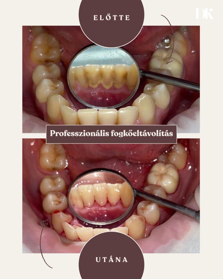 Professzionális fogkőeltávolítás
