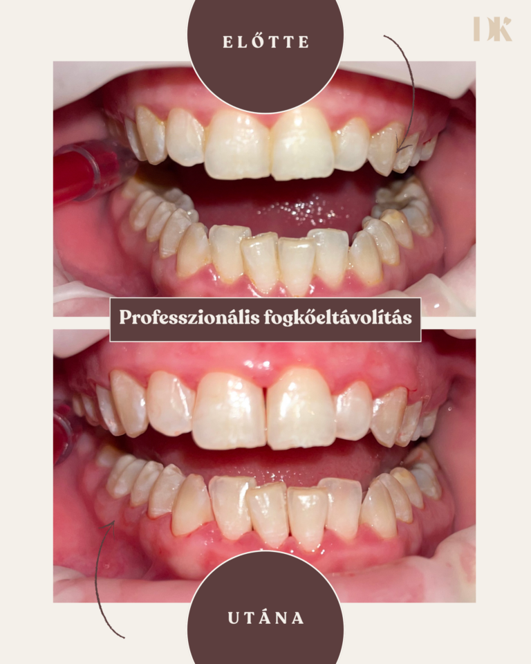 Professzionális fogkőeltávolítás