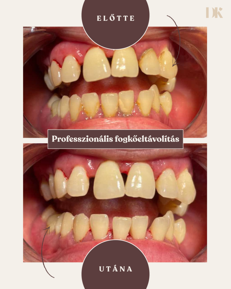 Professzionális fogkőeltávolítás